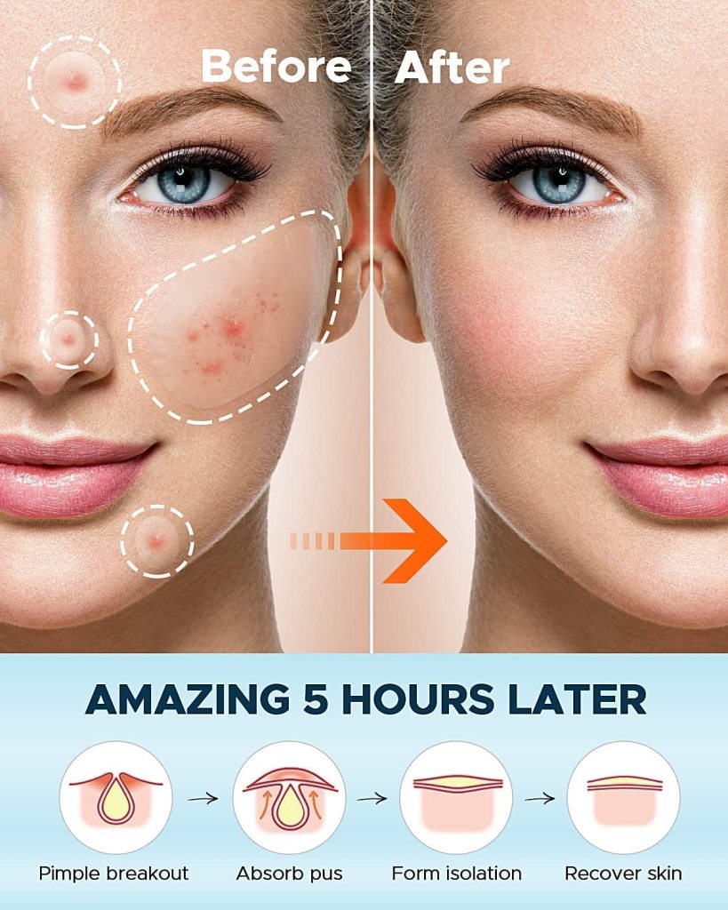 36 Pcs Acne Patch Pimple Patch Beauty Products